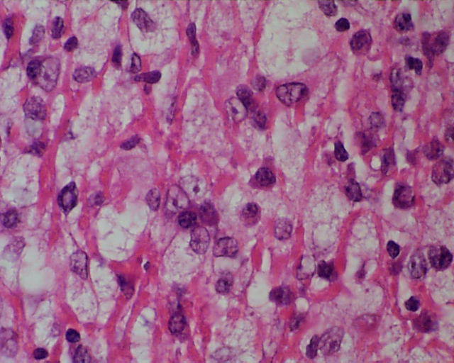 Imagen de Ganglio linftico laterocervical en paciente de 18 aos / Lateral cervical lymph node in 18 years old patient.