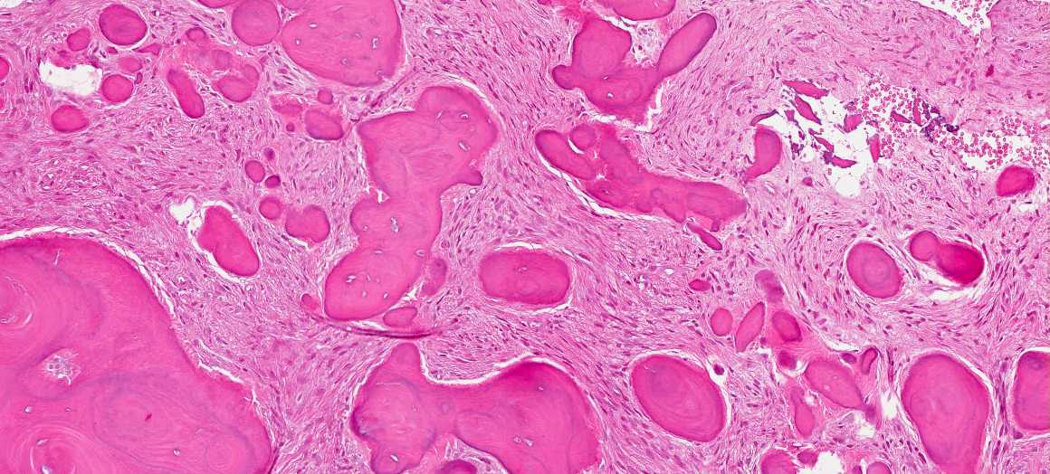 Imagen de Lesin radiolcida mandibular en mujer de 53 aos/Mandibular radiolucent lesion in 53 years old female.