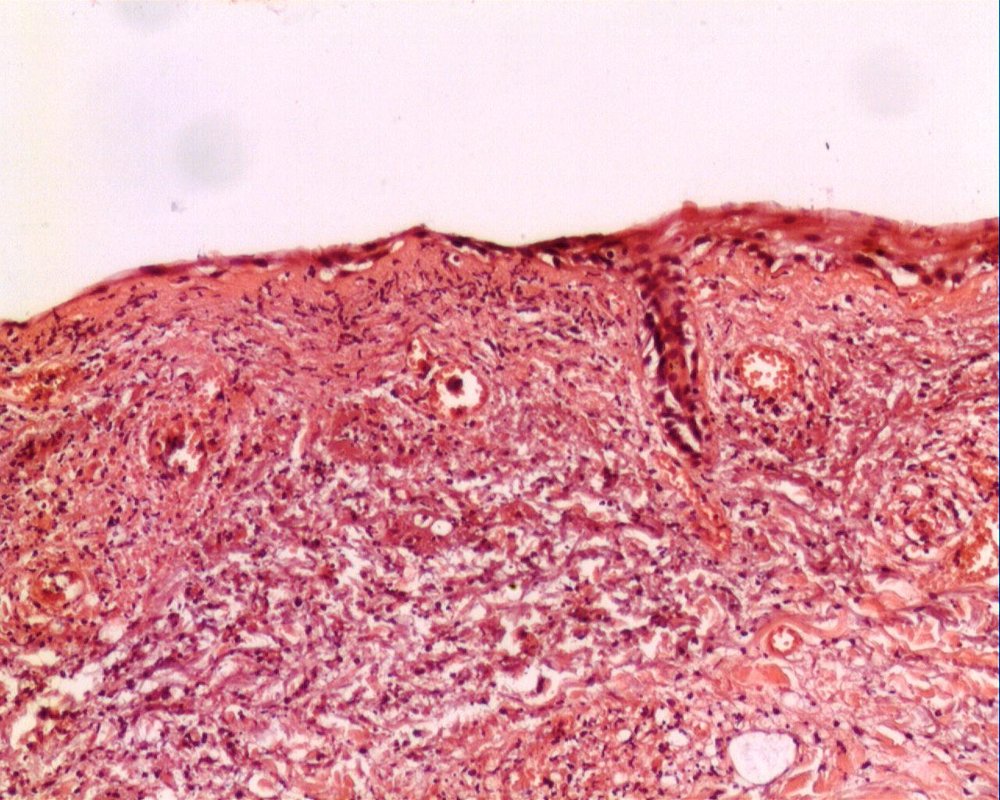 Imagen de Lesiones mculares cutneas purpricas en varn de 65 aos / Cutaneous macular purpuric lesions in a 65 y-o male.
