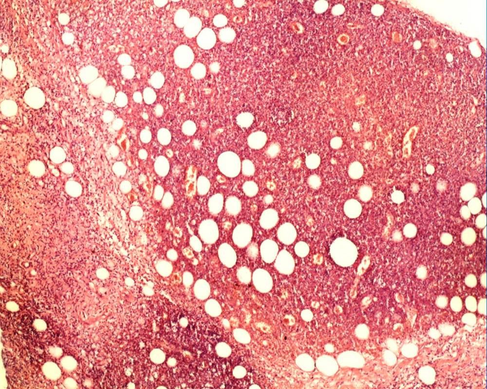Imagen de Lesiones mculares cutneas purpricas en varn de 65 aos / Cutaneous macular purpuric lesions in a 65 y-o male.