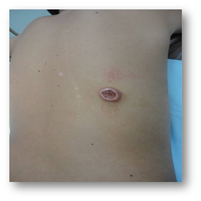 Imagen de Lesin cutnea en nio de 11 aos/Cutaneus lesion in 11 y-o boy.