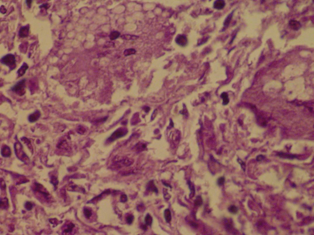 Imagen de Lesin nodular subpleural en mujer de 44 aos / Subpleural nodular lesion in 44-years old female.
