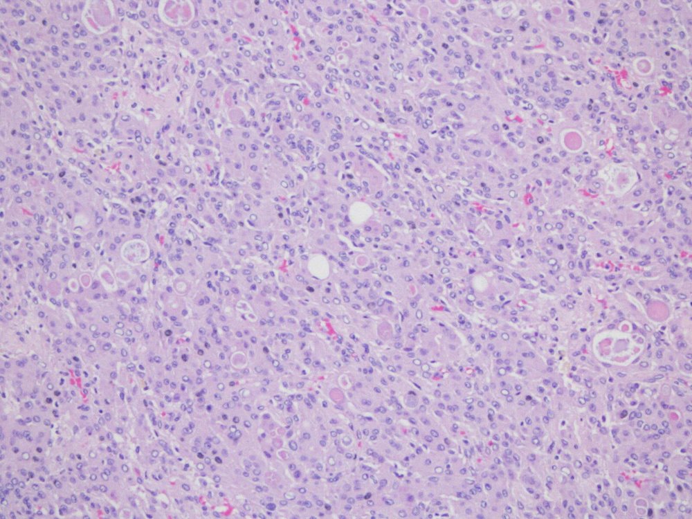 Imagen de Tumor cerebral en paciente con alteraciones analiticas/Brain tumor in a patient with laboratory abnormalities.