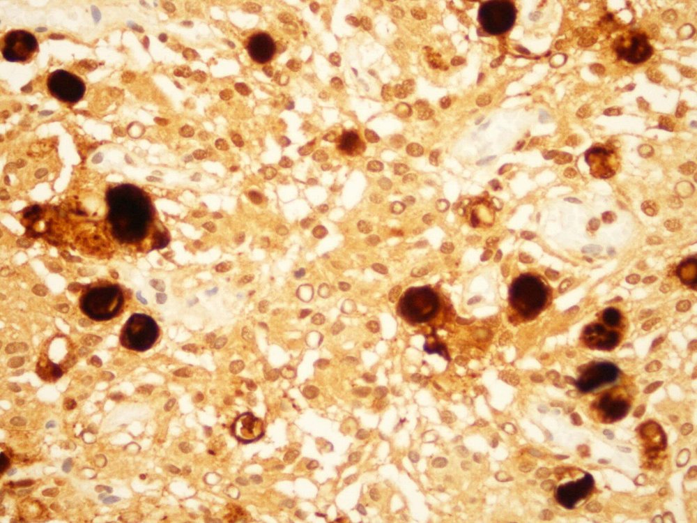 Imagen de Tumor cerebral en paciente con alteraciones analiticas/Brain tumor in a patient with laboratory abnormalities.