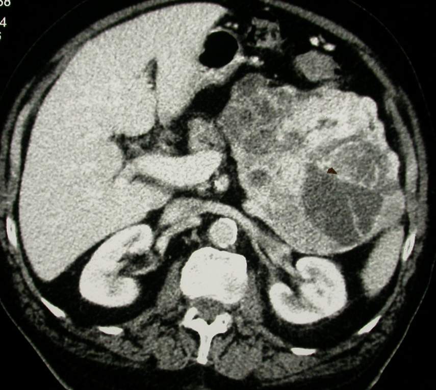 Imagen de Retroperitoneal tumor mass in 63-years old man.