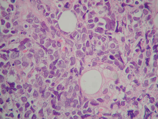 Imagen de Ganglio linftico inguinal en varn de 48 aos / Inguinal lymph node in 48 years old male.