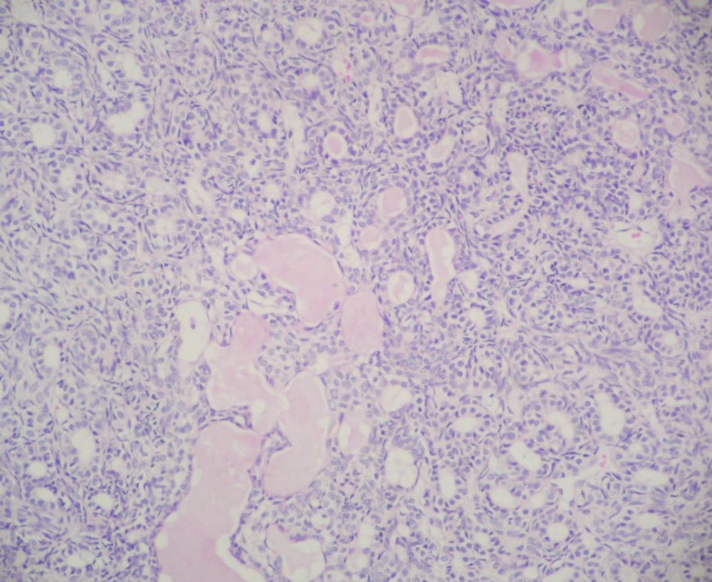 Imagen de Tumor bajo la glndula partida de lento crecimiento/Slow growing mass under the parotid gland.