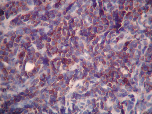 Imagen de Ganglio linftico inguinal en varn de 48 aos / Inguinal lymph node in 48 years old male.