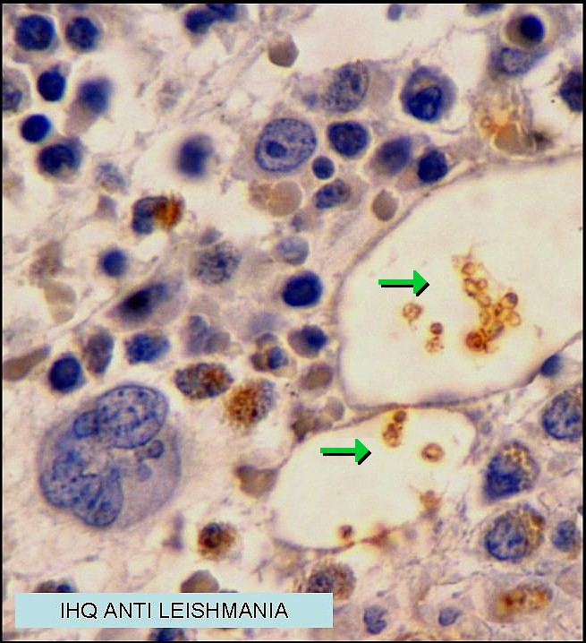 Imagen de Medula ssea, HIV +.  Bone marrow, HIV +.