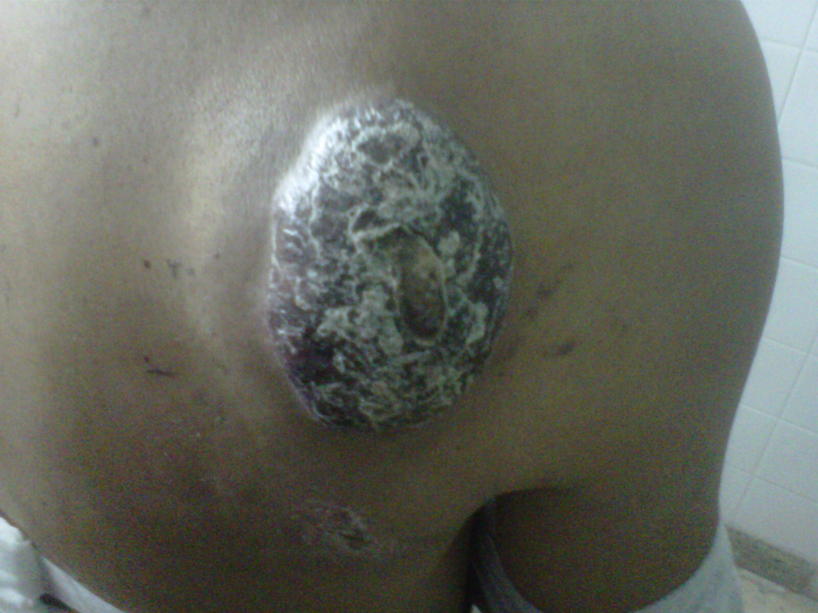 Imagen de Tumores Cutáneos Múltilples en Paciente Masculino con antecedente de Tumor Testicular.
