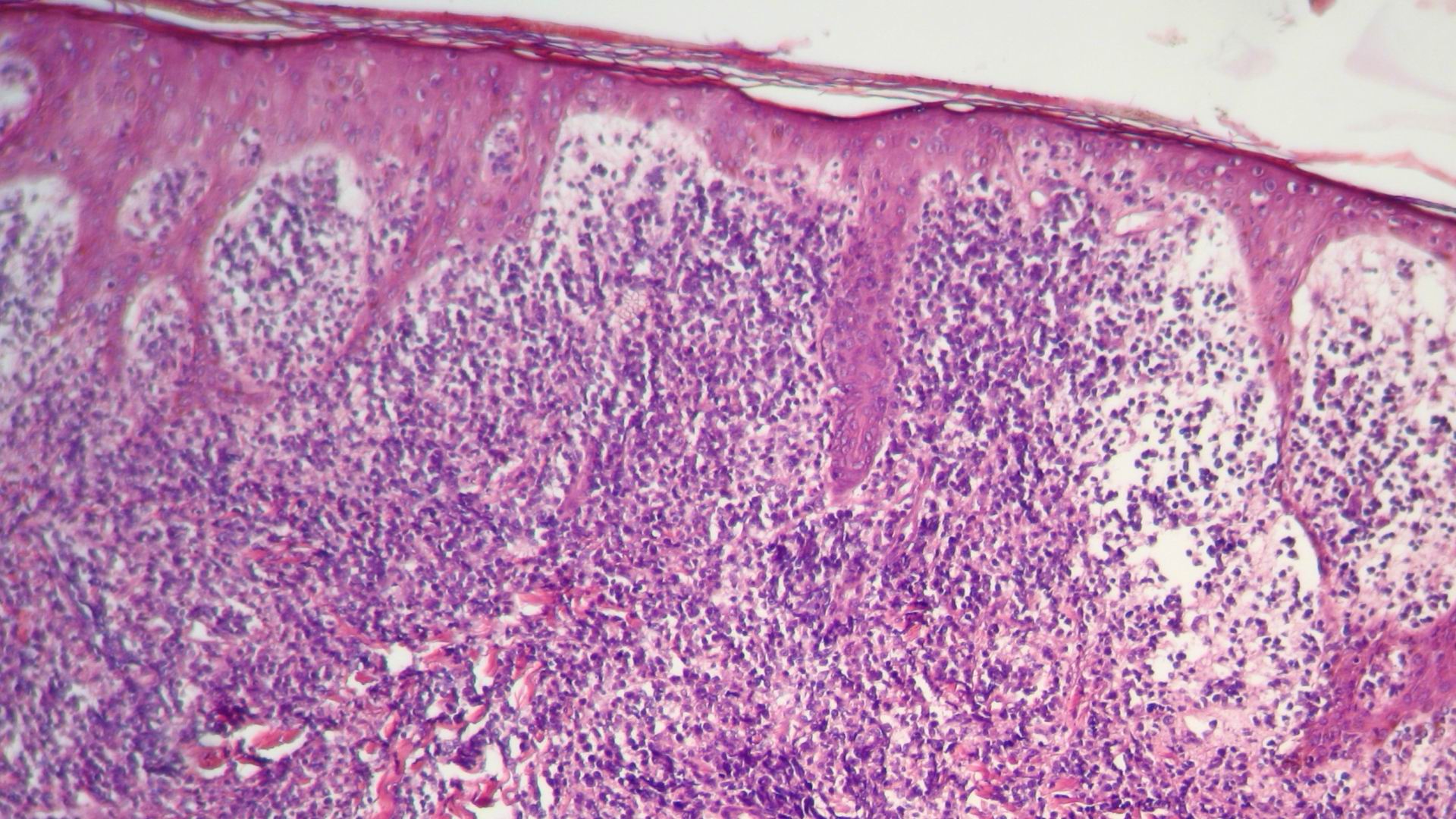 Imagen de Tumores Cutáneos Múltilples en Paciente Masculino con antecedente de Tumor Testicular.
