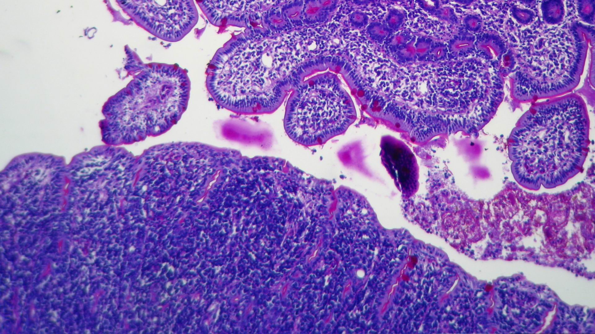 Imagen de Tumor Intestinal Ulcerado 