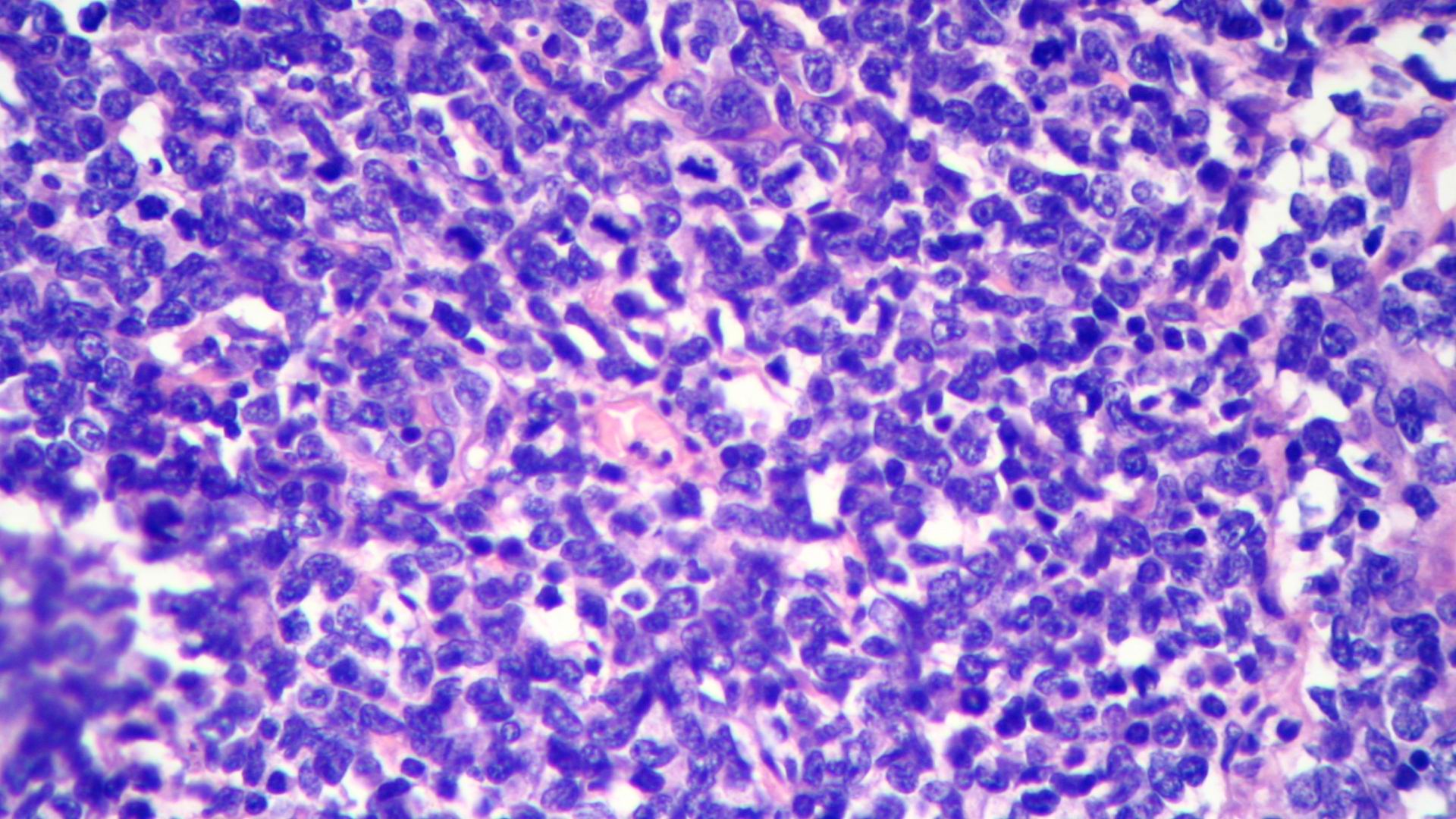 Imagen de Tumor Intestinal Ulcerado 