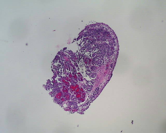 Imagen de Lesin endobronquial en mujer de 41 aos / Endobronchial lesion in 41 y-o female.