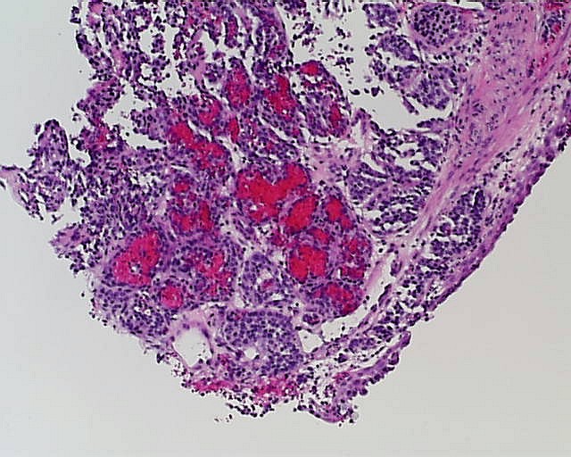 Imagen de Lesin endobronquial en mujer de 41 aos / Endobronchial lesion in 41 y-o female.