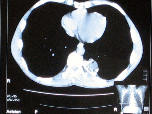 Imagen de Tumor en arco posterior de 10 costilla / Tumor in posterior arch of tenth rib.