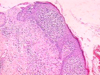 Imagen de Leso cutnea extensa em homem de 68 anos/ Extensive cutaneous lesion in a 68 years old man