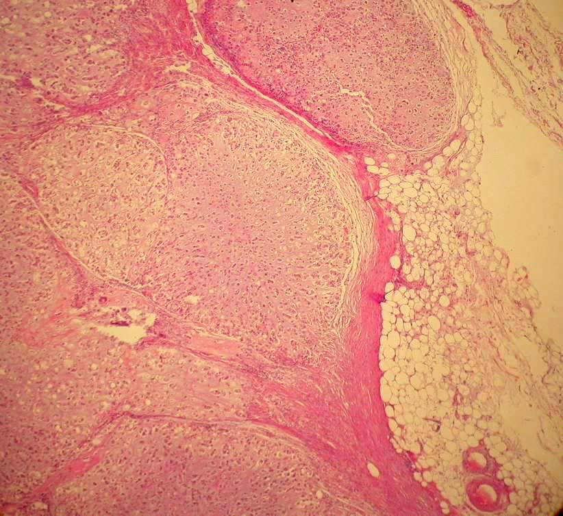 Imagen de Nodular lesion in the left parotid gland region / Lesione nodulare della regione parotidea sinistra