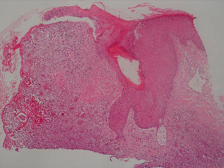 Imagen de Lesin nodular en regin infra-auricular / Nodular  lesion in the  retro-auricular region