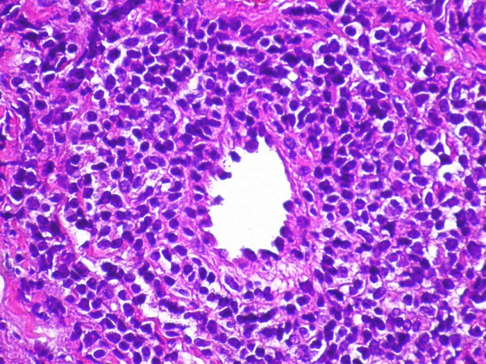Imagen de  Biopsia de nodulos subcutaneos de mama izquierda / Left breast subcutaneous tumor biopsy
