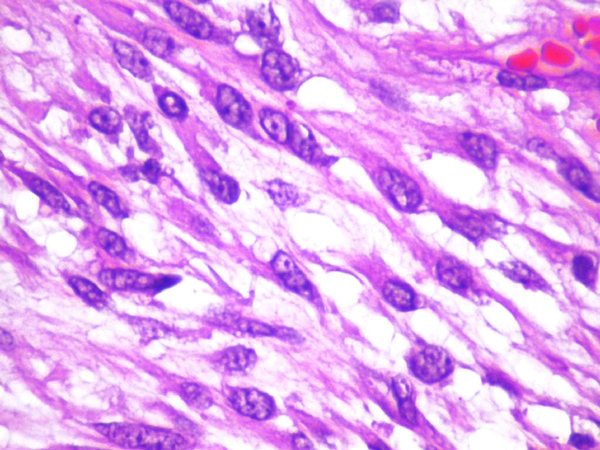 Imagen de Tumor en pared posterior de estmago /  Tumor in posterior wall of stomach body