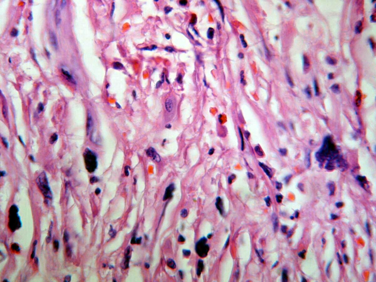 Imagen de Colecistectoma por colecistitis crnica / Cholecystectomy by chronic cholecystitis