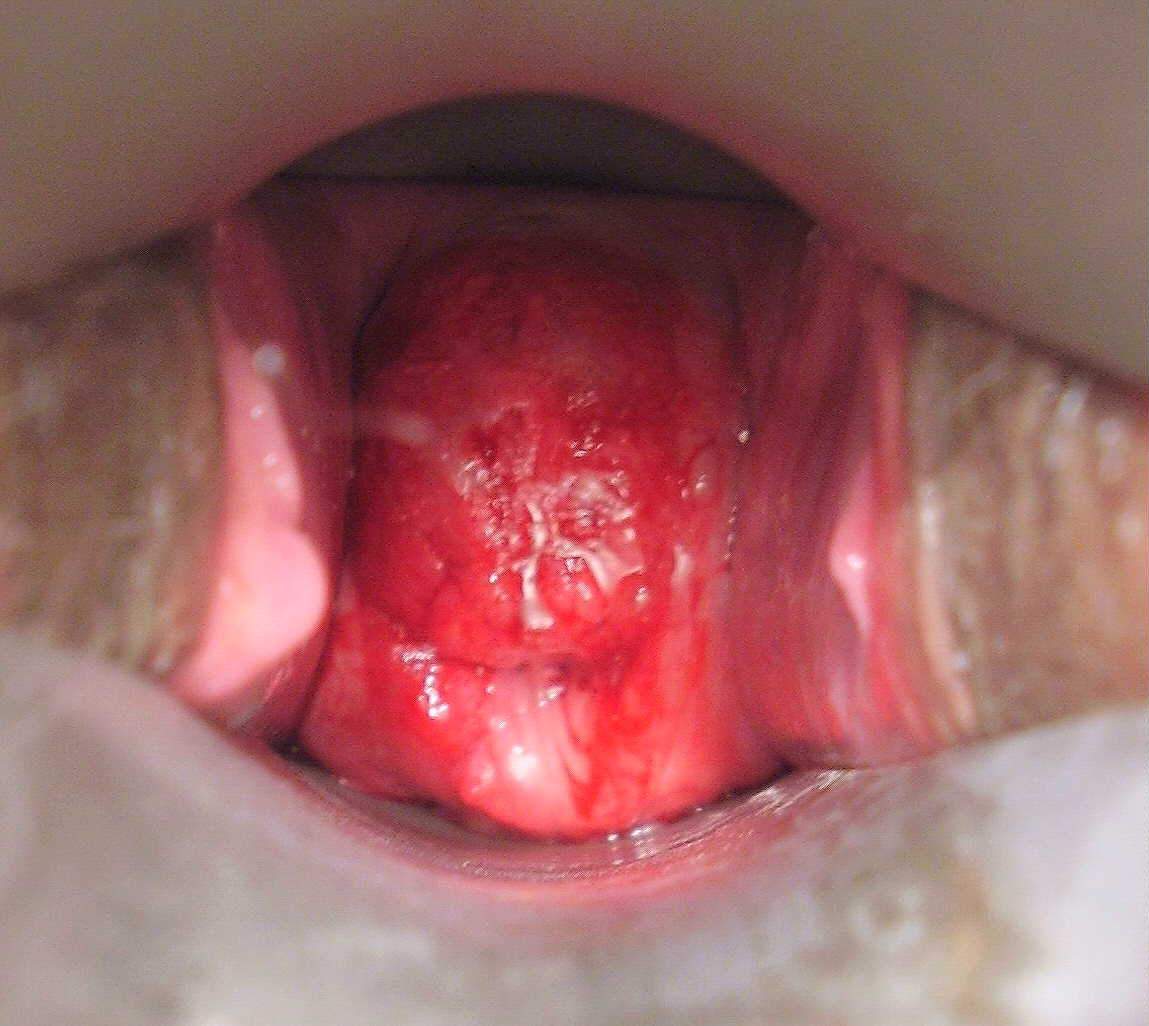 Imagen de Citologa de crvix en mujer joven / Cervical smear in young female
