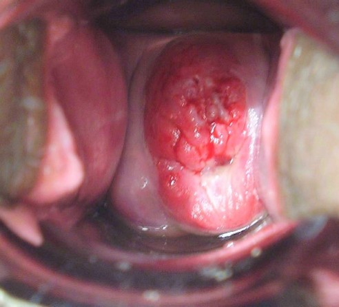 Imagen de Citologa de crvix en mujer joven / Cervical smear in young female