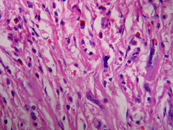 Imagen de Colecistectoma por colecistitis crnica / Cholecystectomy by chronic cholecystitis