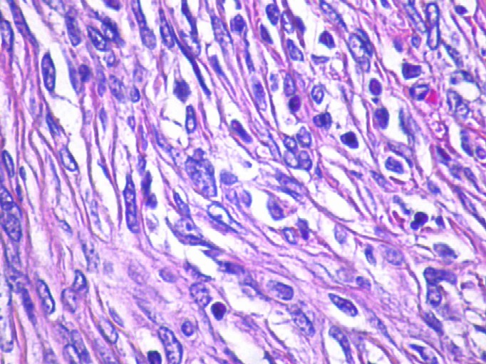 Imagen de Neoplasia Menngea de Regin Occipital / Occipital Meningeal Tumor. 