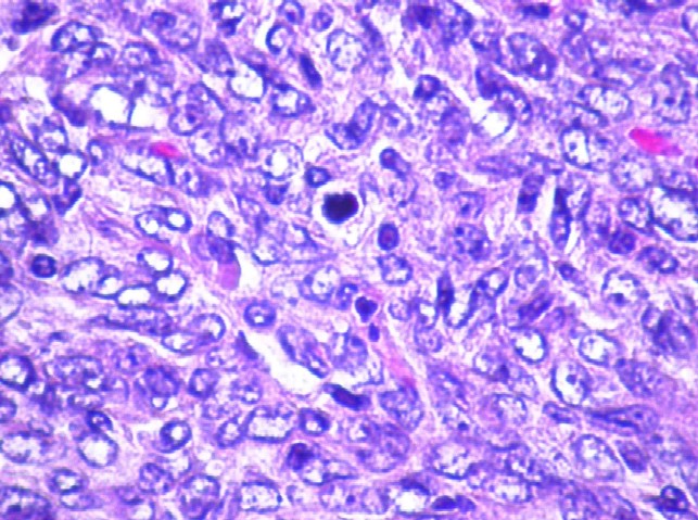 Imagen de Neoplasia Menngea de Regin Occipital / Occipital Meningeal Tumor. 