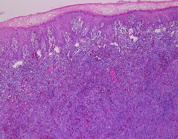Imagen de Amgdala palatina y enca en varn de 35 / Tonsil and gingiva in 35 y-o male.