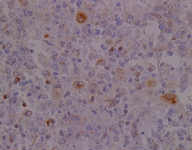 Imagen de Ganglio linftico laterocervical en mujer de 45 aos / Lateral cervical lymph node in 45 y-o female.