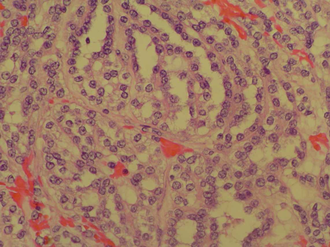 Imagen de Tumor renal en mujer de 52 aos / Kidney tumor in 52 y-o female.