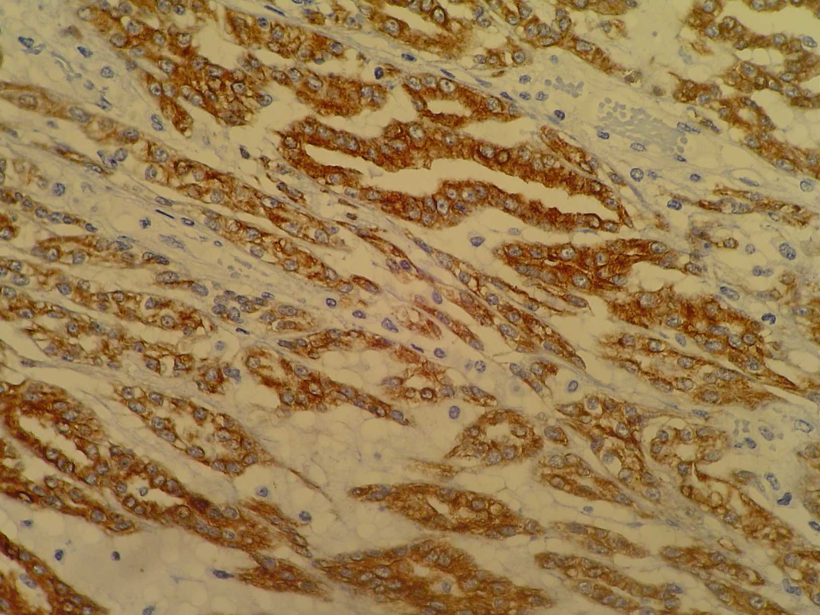 Imagen de Tumor renal en mujer de 52 aos / Kidney tumor in 52 y-o female.
