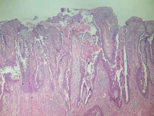 Imagen de Mujer de 43 aos con lesion eritematosa y descamativa  en region vulvar. / 43 year old woman, with erythematous desquamative vulvar lesion