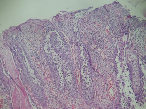 Imagen de Mujer de 43 aos con lesion eritematosa y descamativa  en region vulvar. / 43 year old woman, with erythematous desquamative vulvar lesion