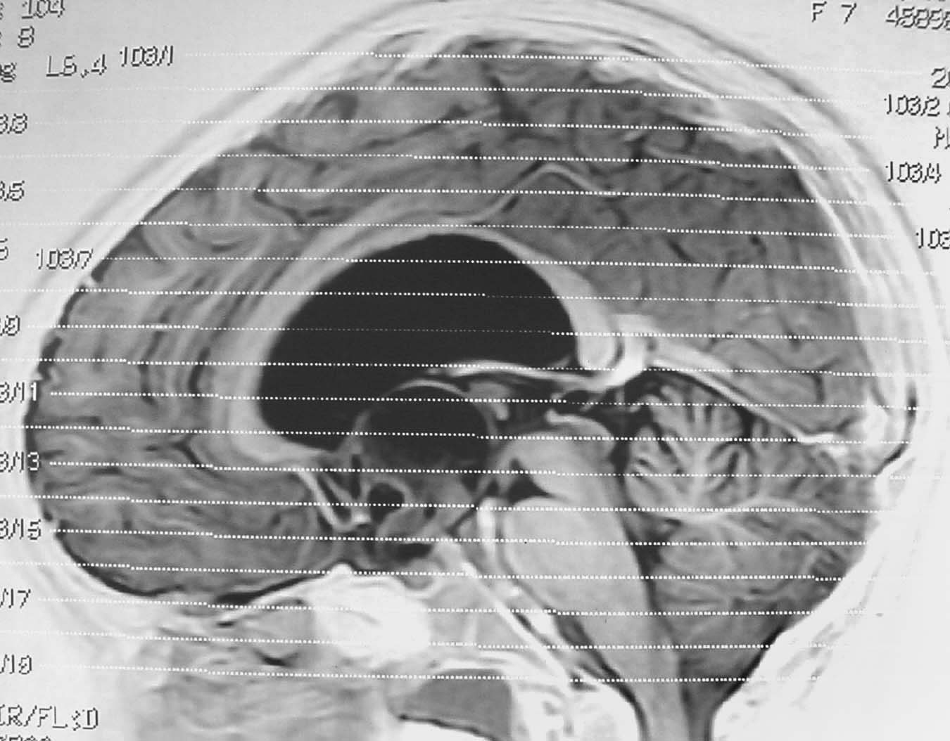 Imagen de Nia de 7 aos con masa supraselar e hipotalmica / Seven year old child with suprasellar and hypothalamic mass.
