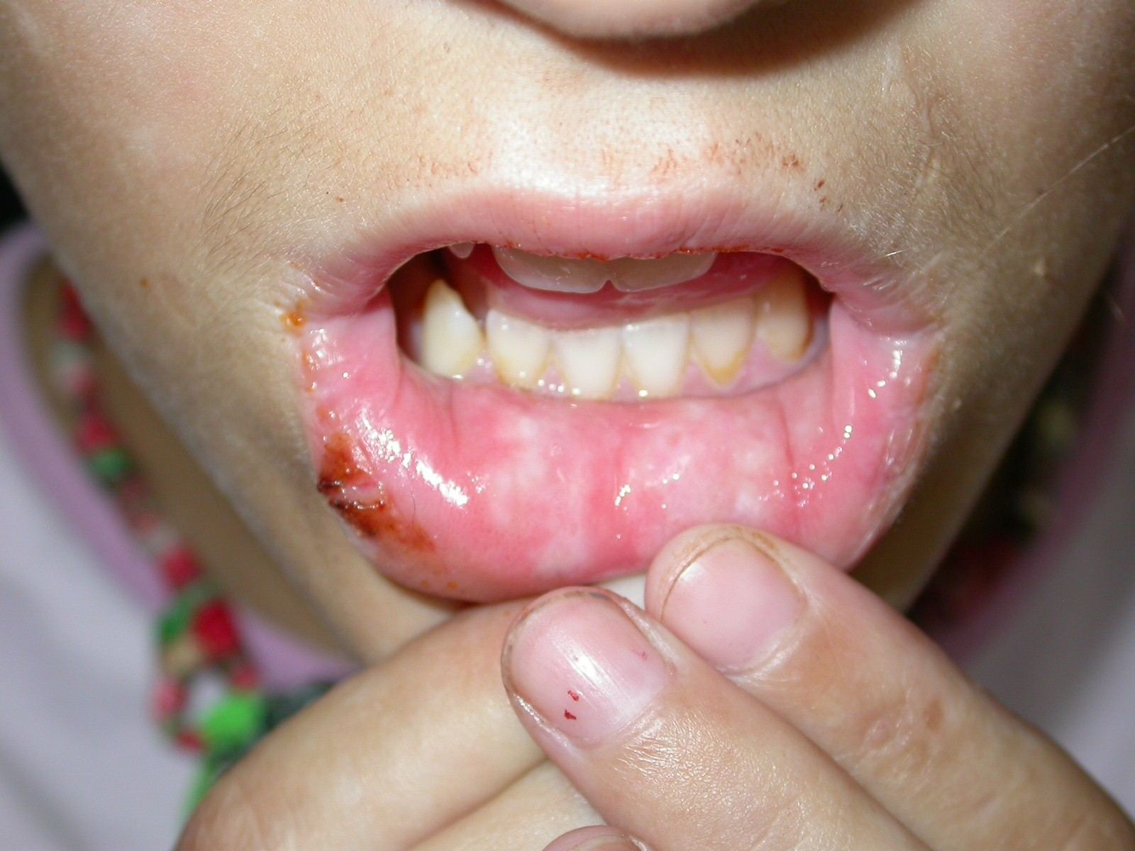 Imagen de Placa blanquecina en mucosa de labio inferior / Whitish patch in lower lip mucosa
