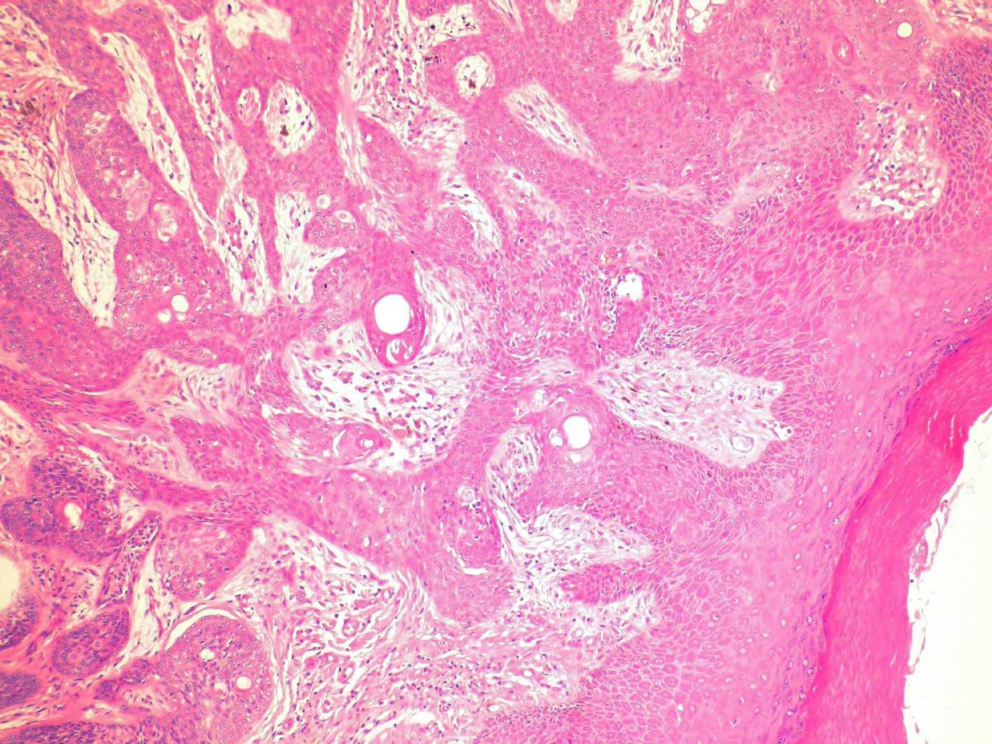 Imagen de Lesin ulcerada en mujer de 76 aos / Ulcerated lesion in 76 y-o female.