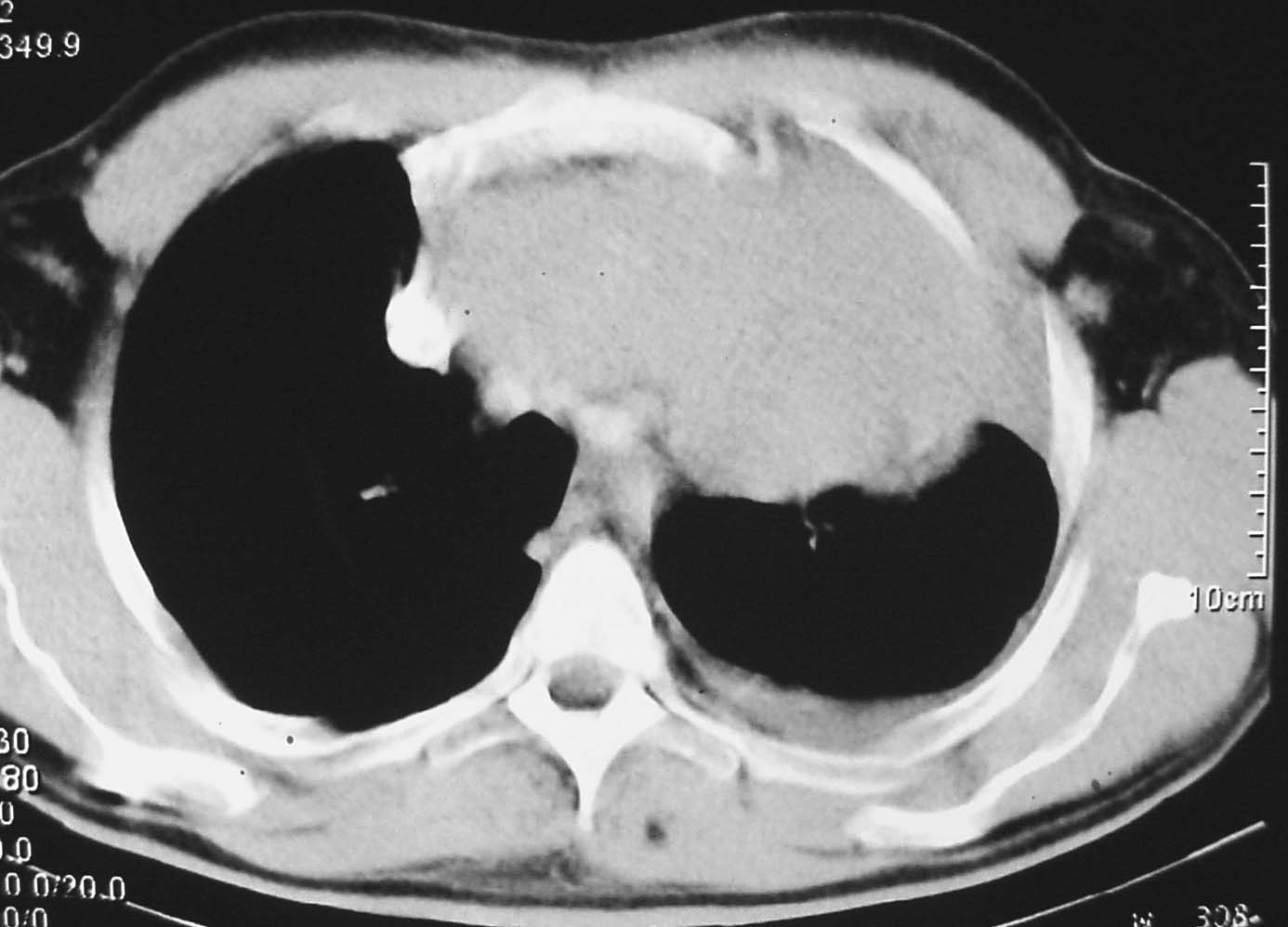 Imagen de Biopsia de masa mediastinal de gran tamao/ Large mediastinal tumour biopsy.