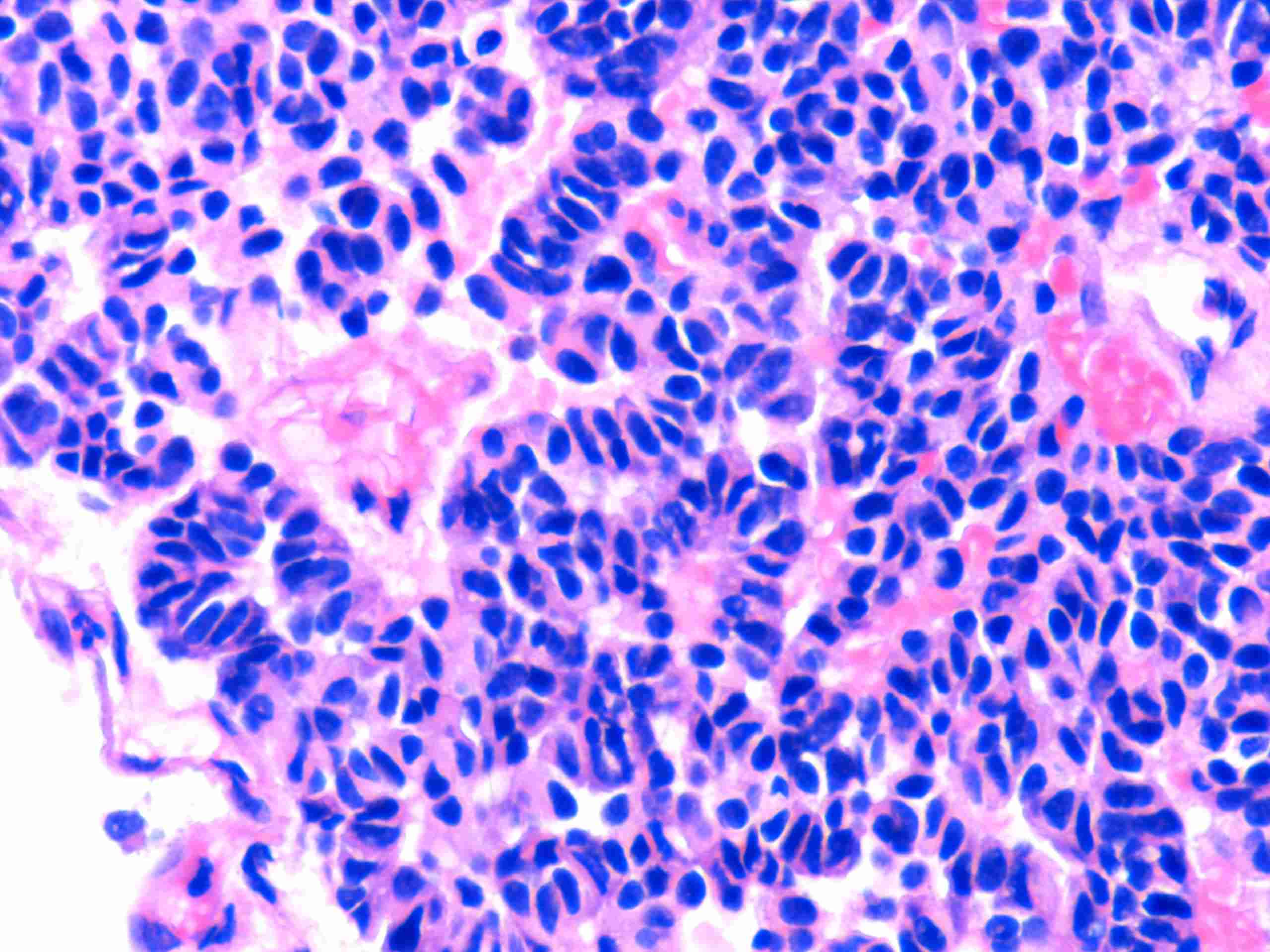 Imagen de Biopsia de masa mediastinal de gran tamao/ Large mediastinal tumour biopsy.