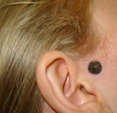 Imagen de A 11-year-old girl with a brownish-black nodule / Nia de 11 aos con nodulo negro-parduzco
