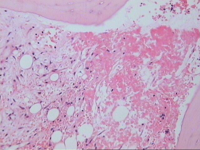 Imagen de Biopsia de Medula Osea/ Bone marrow biopsy.