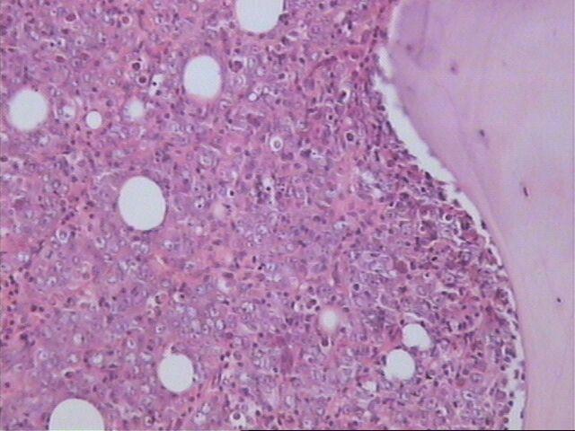 Imagen de Biopsia de Medula Osea/ Bone marrow biopsy.