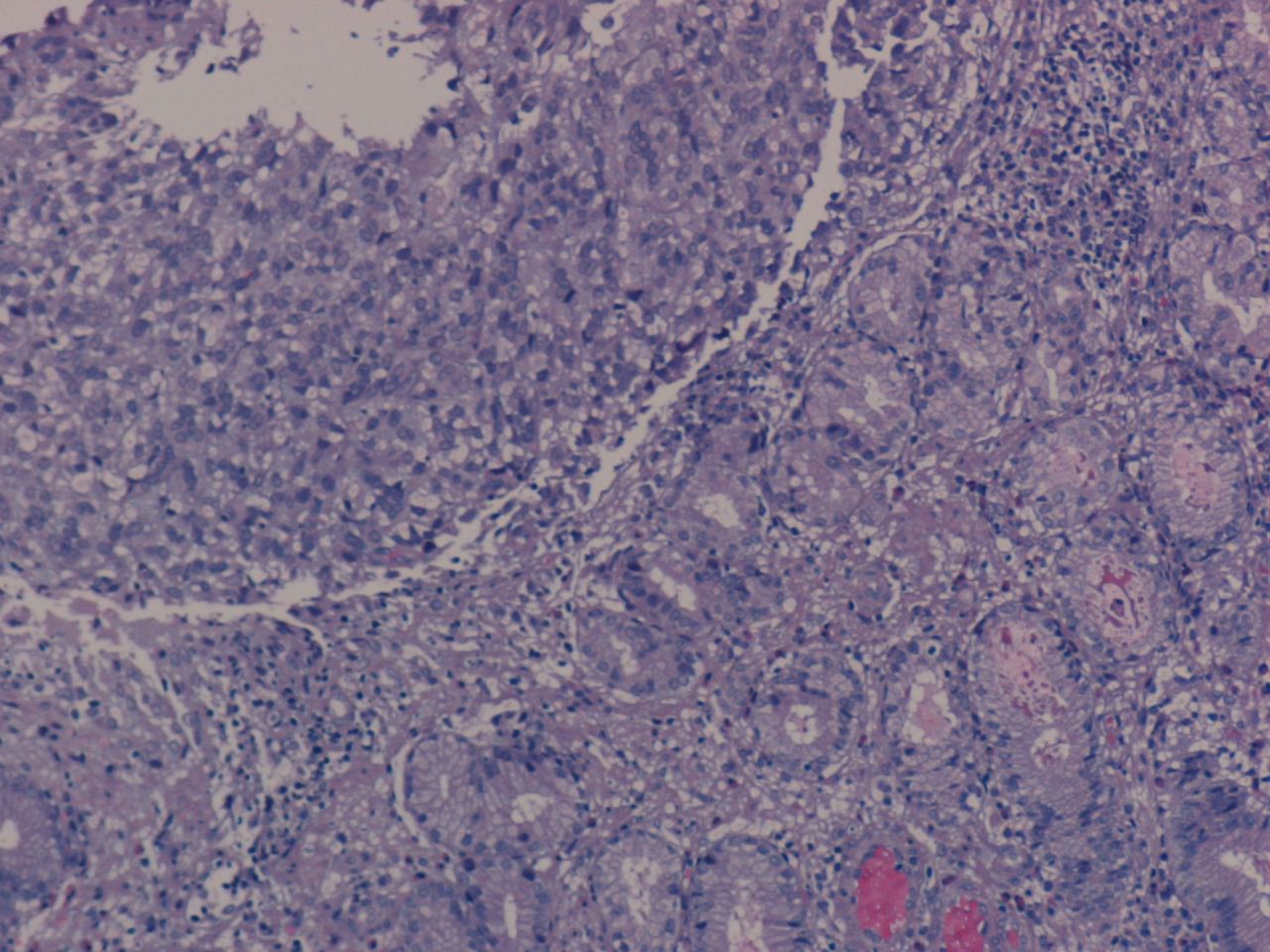 Imagen de Tumor submucoso gstrico / Gastric submucosal tumor.