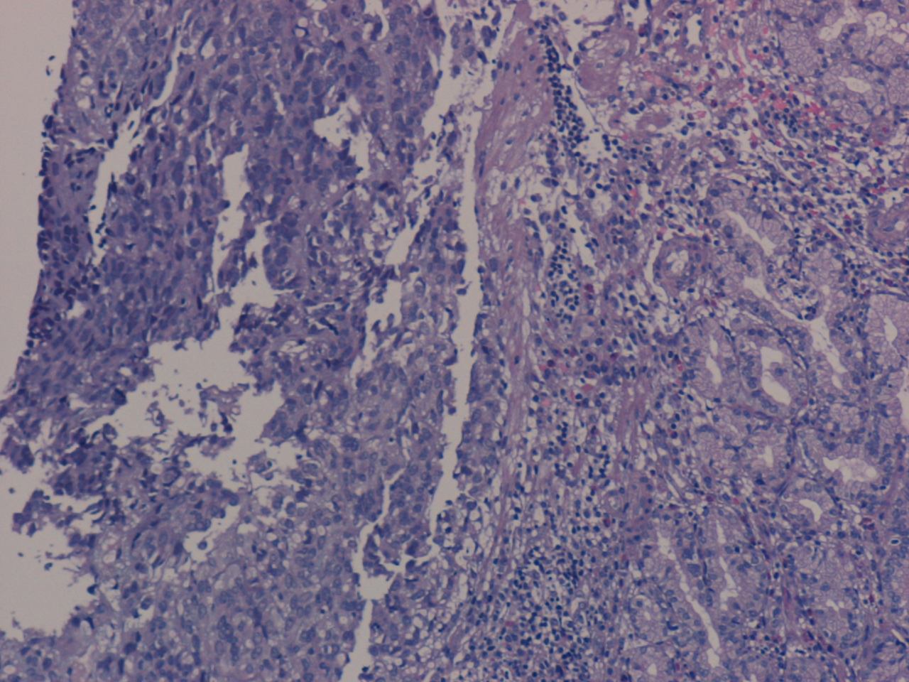 Imagen de Tumor submucoso gstrico / Gastric submucosal tumor.
