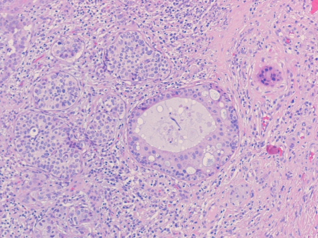 Imagen de Lesión eritemato-escamosa en vulva / Vulvar erythemato-squamous lesion.
