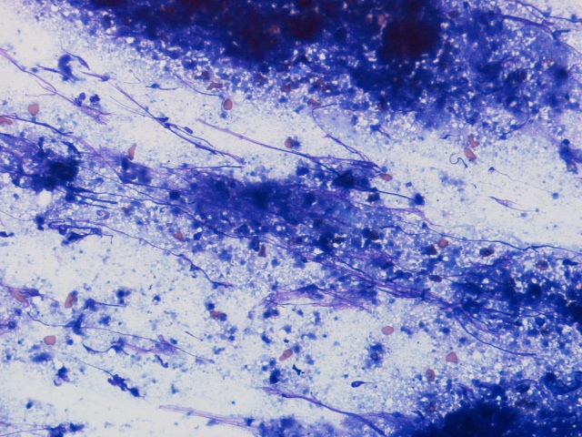 Imagen de Nódulo laterocervical en mujer de 30 años / Lateral cervical nodule in 30 y-o female.