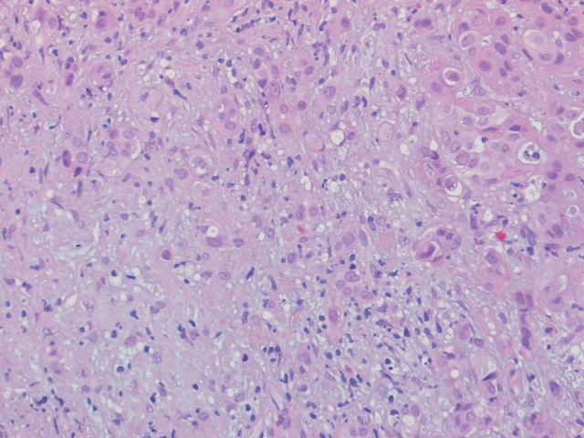 Imagen de Masa hepática / Liver mass.